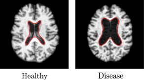 Example of anatomical shape variation in medical imaging